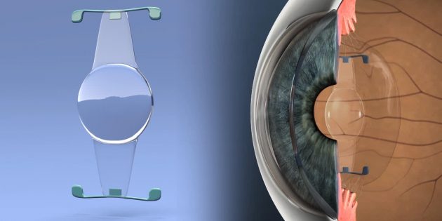 Как восстановить зрение за один день: разбираем современные методы лечения